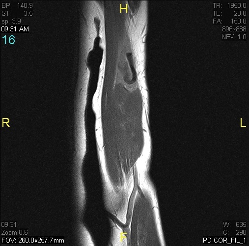 Figure 3 for case Rupture of tendon of long head of biceps brachii ( RID1944 )
